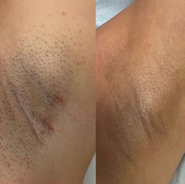 Beame Permanent IPL Hair Removal Device