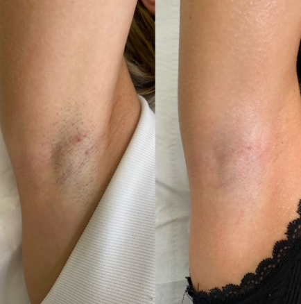 Beame Permanent IPL Hair Removal Device