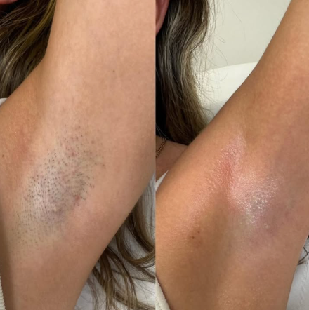 Beame Permanent IPL Hair Removal Device