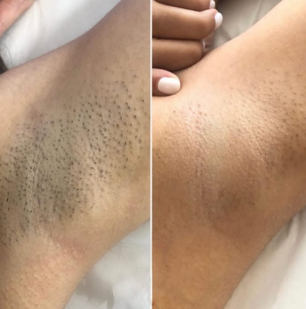Beame Permanent IPL Hair Removal Device