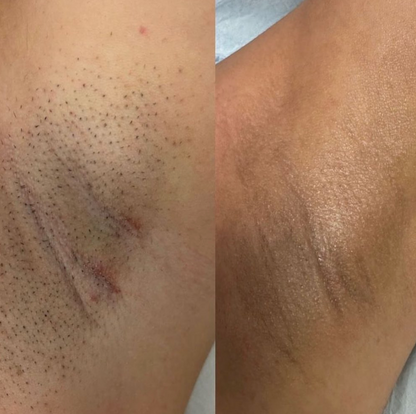 Beame Permanent IPL Hair Removal Device
