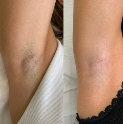Beame Permanent IPL Hair Removal Device