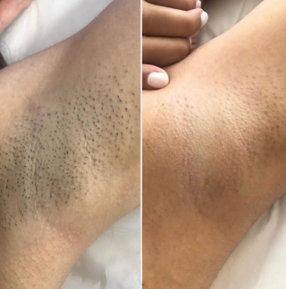 Beame Permanent IPL Hair Removal Device